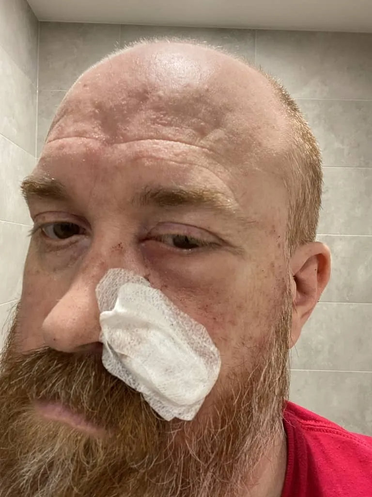 A man with a bandage on his face